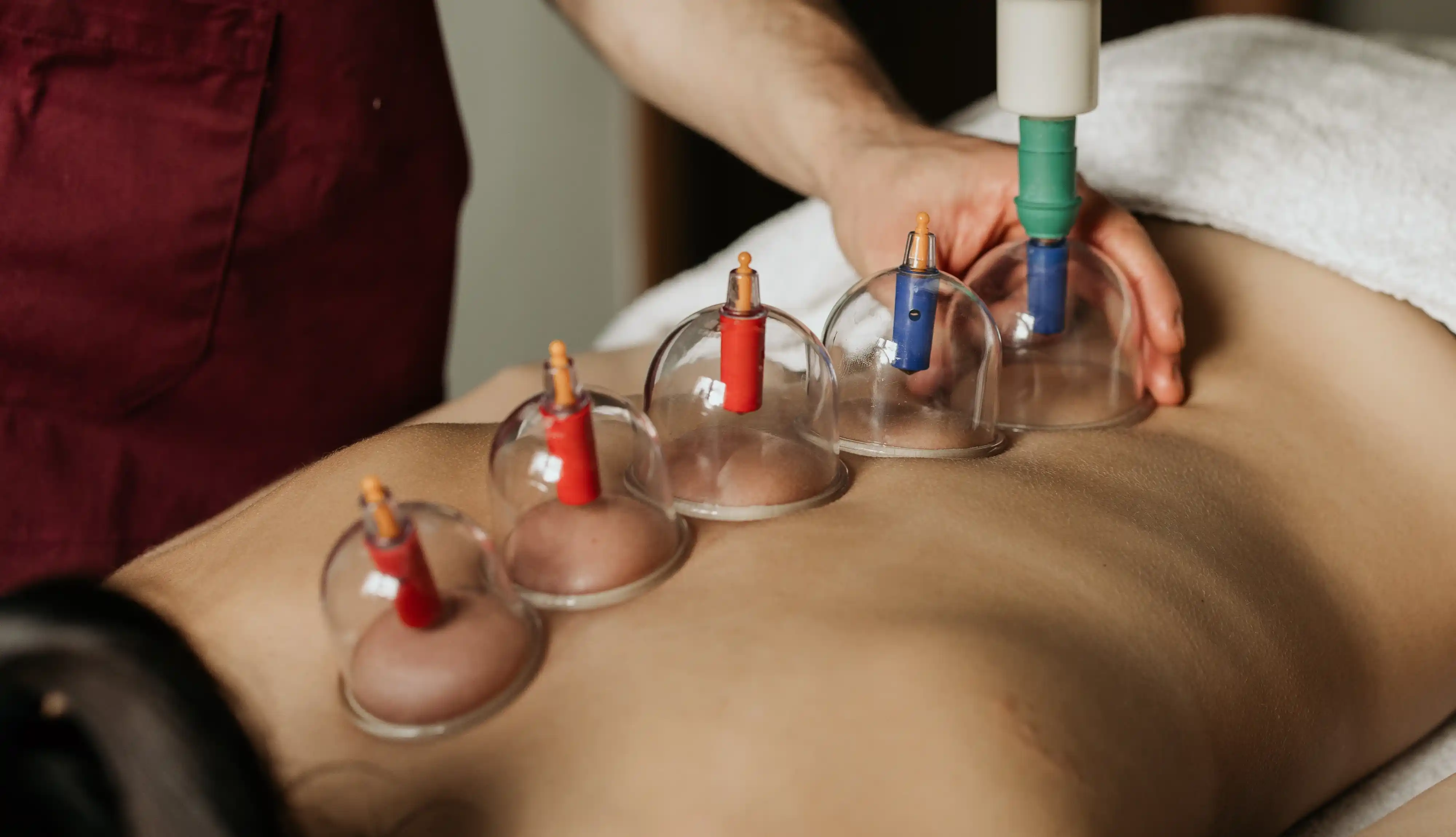 Coppettazione, Gua Sha, Moxa